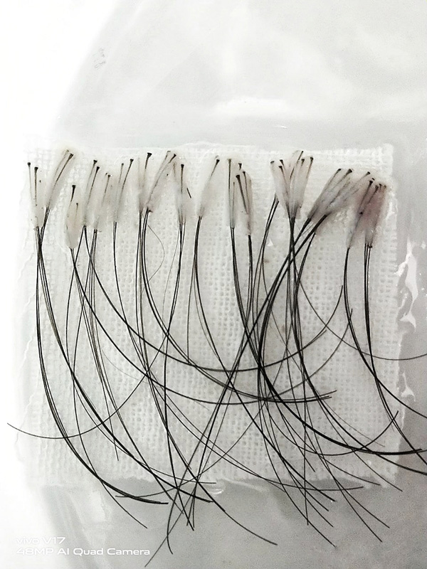 Long hair transplant