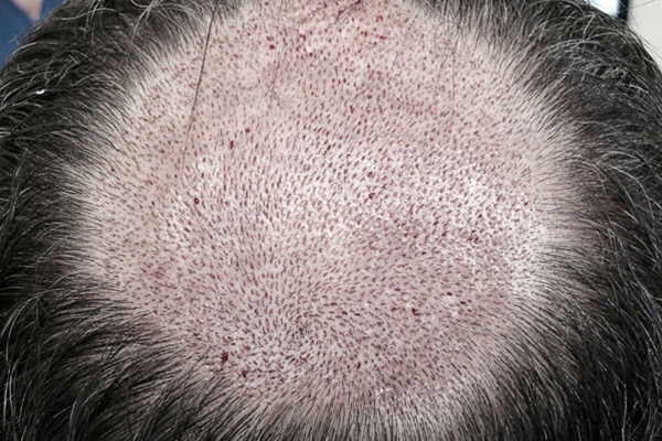 How does hair transplantation work?