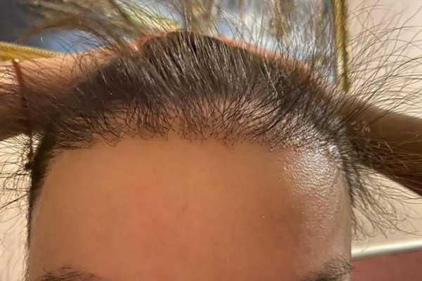 Consequences of hair transplantation in Turkey