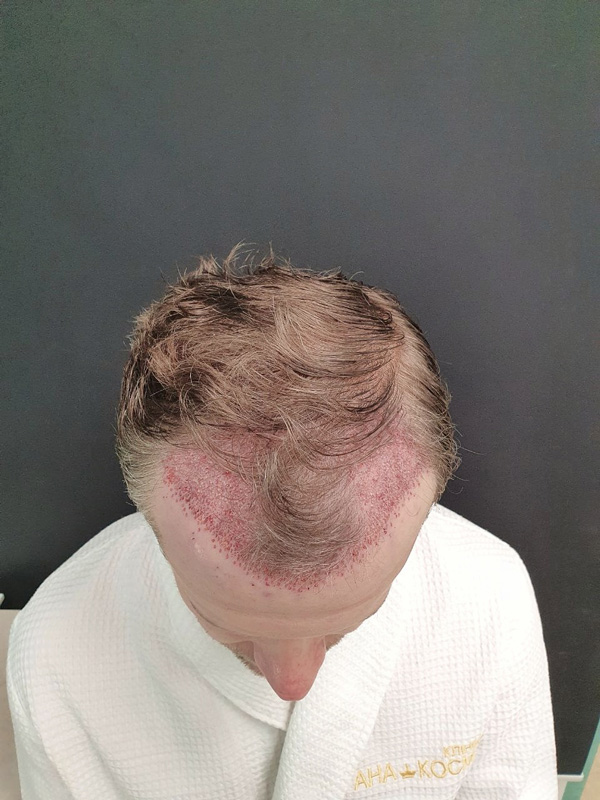 Graft transplantation