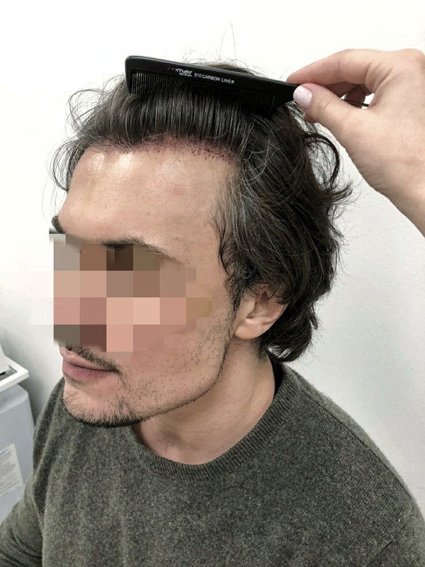 Long hair transplant