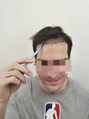 How is hair transplantation done?