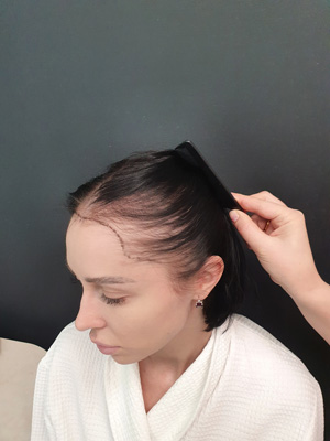 Hair loss