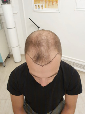 Alopecia in men