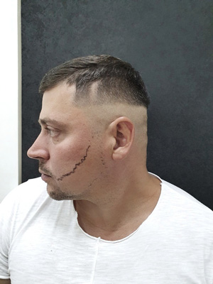 Beard transplant